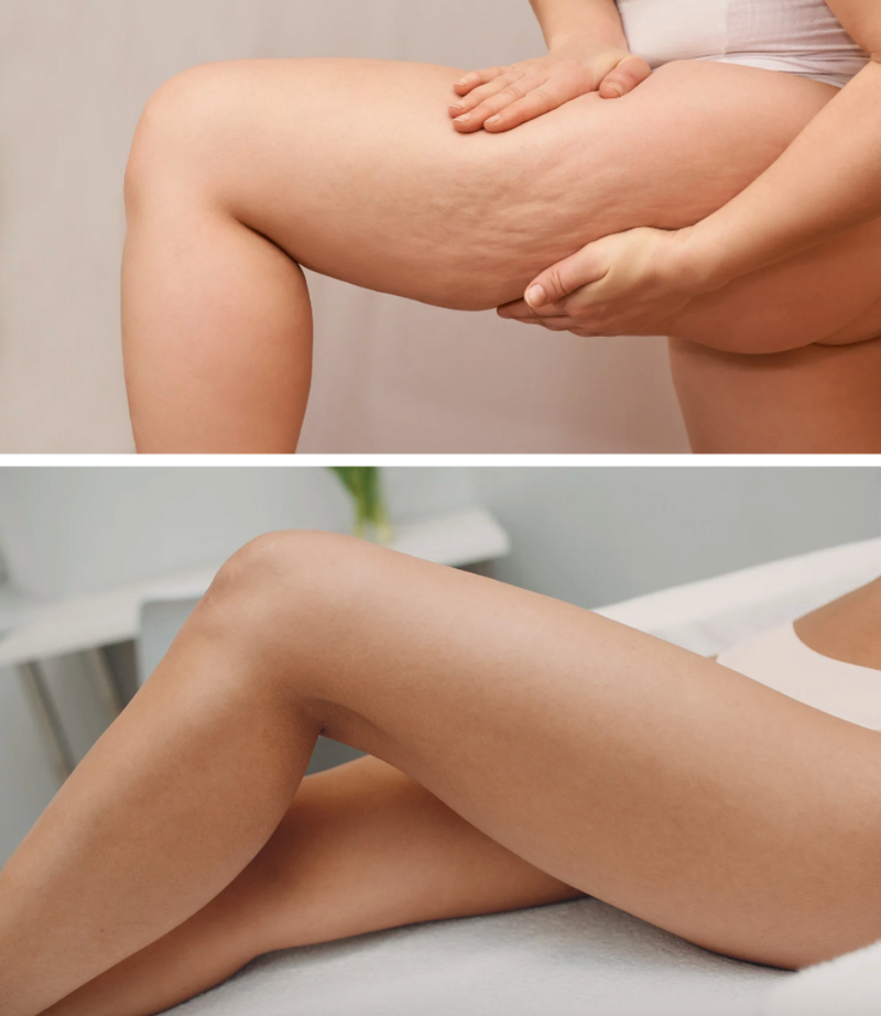Cellulite Reduction & Skin Tightening Treatment