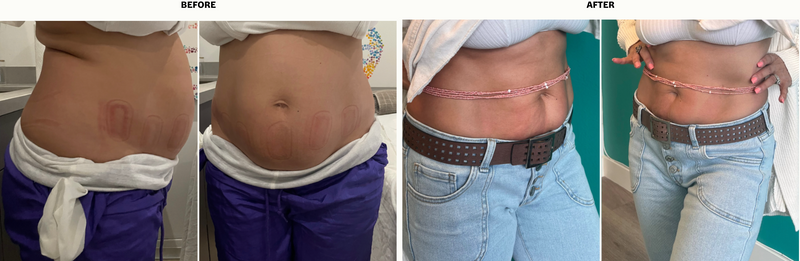 Passive Non-Invasive Fat Reduction Therapy