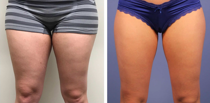 Passive Non-Invasive Fat Reduction Therapy