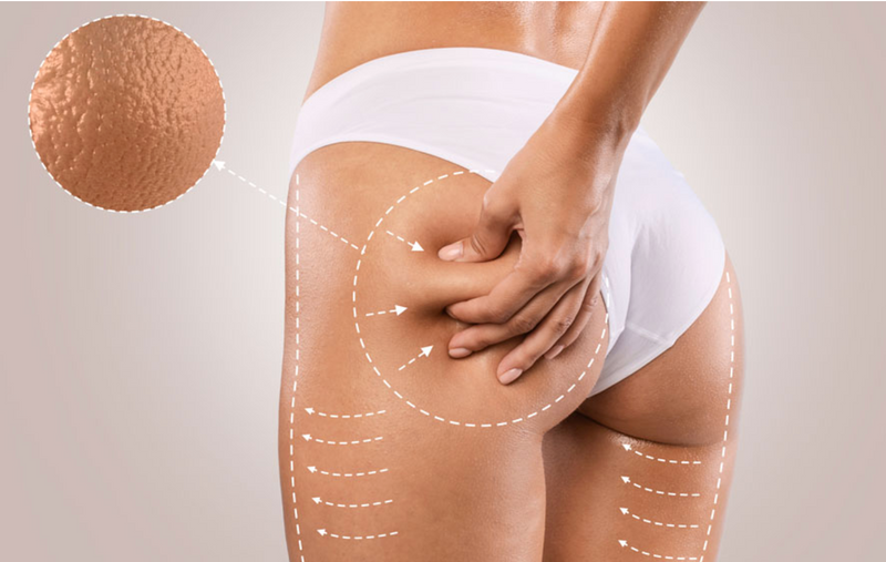 Cellulite Reduction & Skin Tightening Treatment